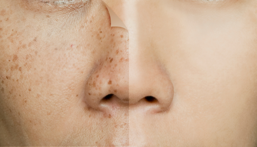 Before,And,After,Retouching,Freckles,On,Asian,Woman,Face,,Skin