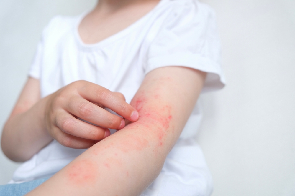 The,Child,Scratches,Atopic,Skin.,Dermatitis,,Diathesis,,Allergy,On,The