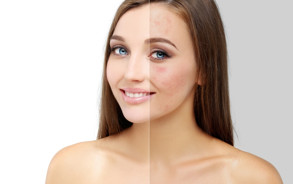 Post-acne,Marks,.treating,Acne,Scars.acne,Scar,Removal