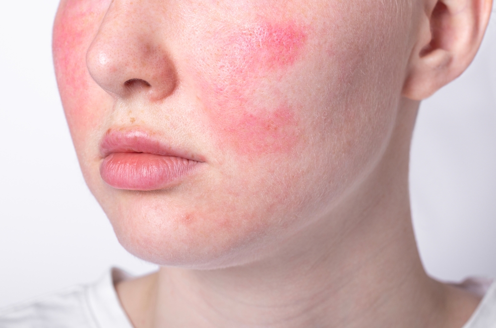 Rosacea,Couperose,Redness,Skin,,Red,Spots,On,Cheeks,,Young,Woman