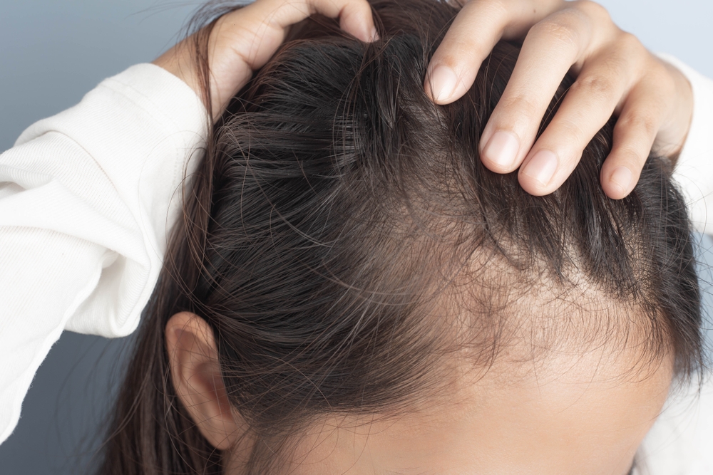 Young,Women,Stressed,And,Having,Hair,Loss,,Thinning,Hair