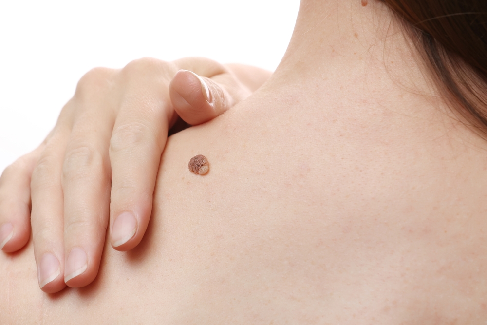Large,Nevus,Wart,On,Young,Female,Shoulder,,Woman,Visiting,Doctor