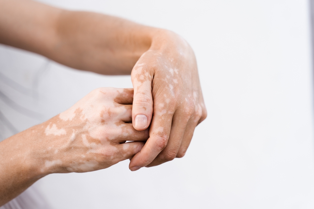 Hands,With,Vitiligo,Skin,Pigmentation,On,White,Background,Close-up.,Lifestyle