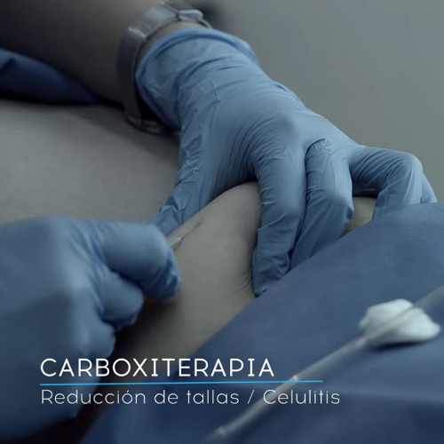 carboxiterapia