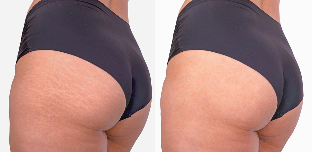 Image,Compare,Before,And,After,Woman,Buttocks,With,Stretch,Marks
