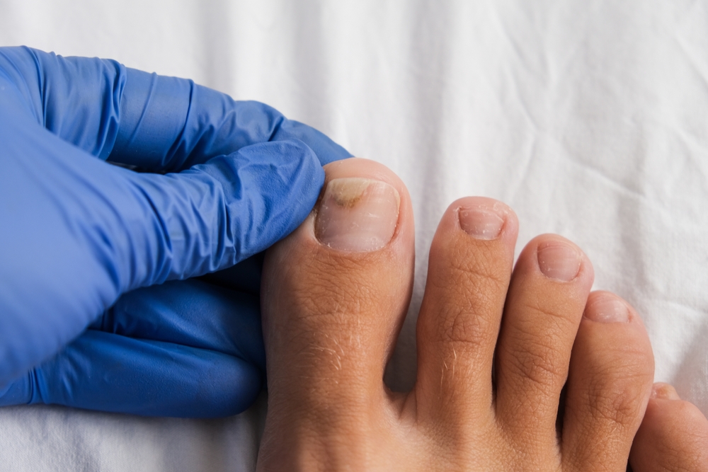 A,Doctor,Examines,Bare,Foot,With,Onycholysis,On,A,Toenail