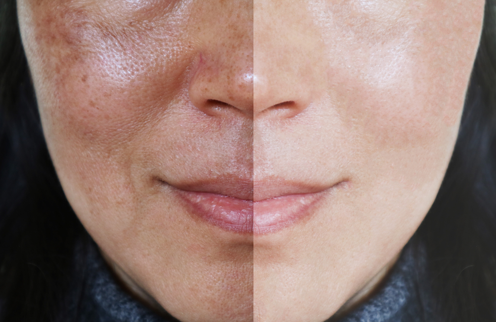 Face,With,Open,Pores,And,Melasma,Before,And,After,Make
