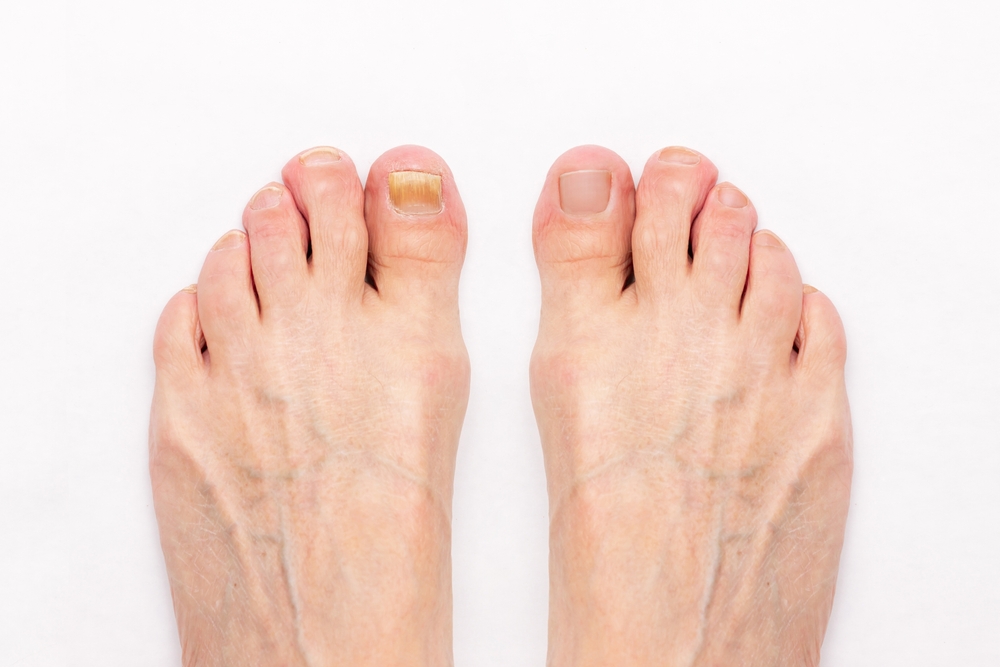 Close-up,Of,A,Male,Foot,With,Yellow,Ugly,Fungus,On