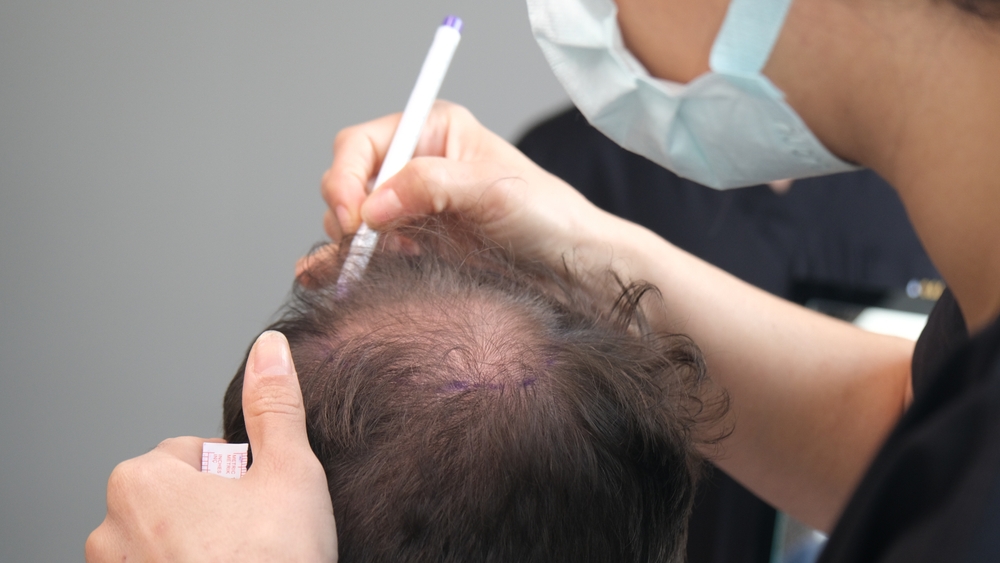 Doctor,Check,Before,Hair,Transplant