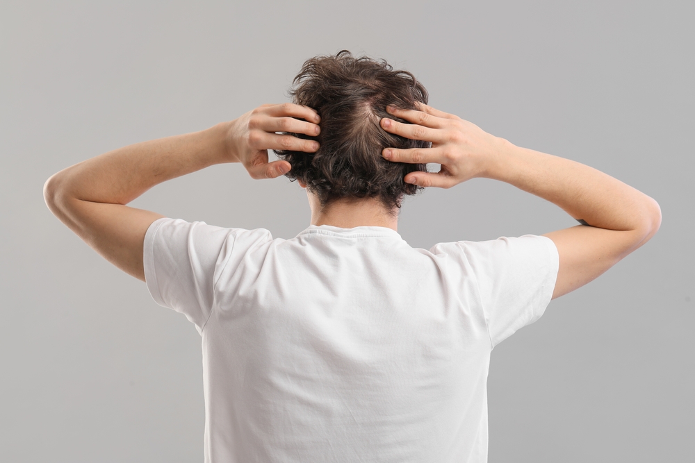 Young,Man,With,Hair,Loss,Problem,On,Grey,Background,,Back