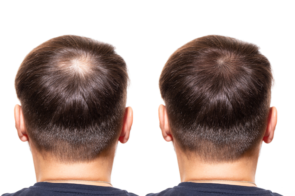 Hair,Loss.,Care,Concept.,Transplantation,Hair.,Men,View,From,The