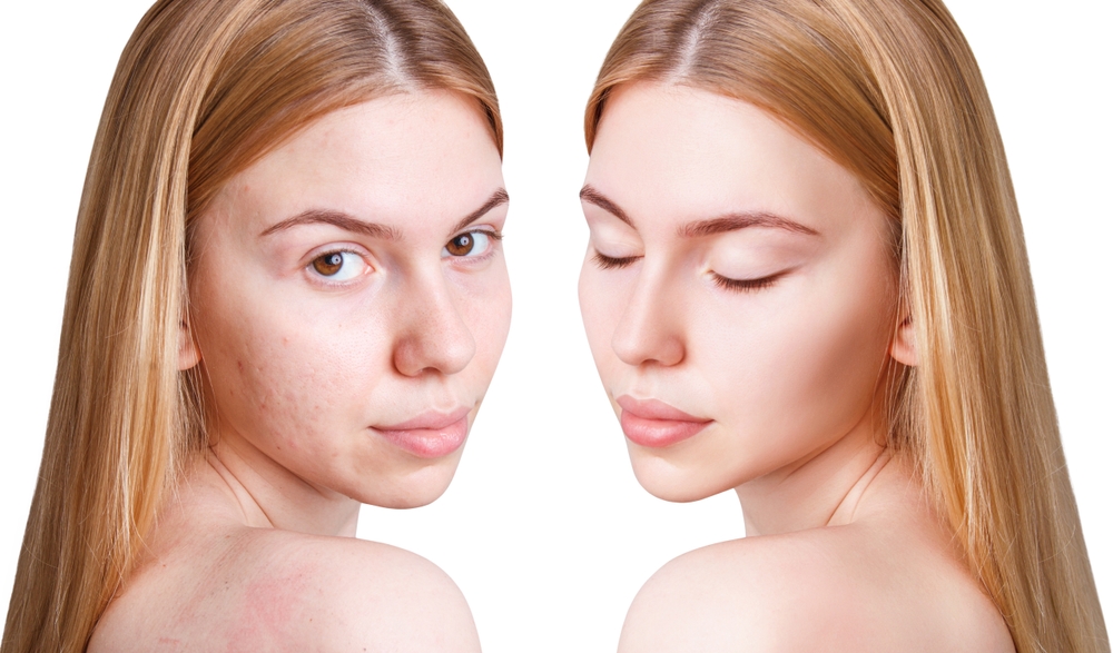 Young,Woman,Before,And,After,Acne,Treatment,And,Make-up.