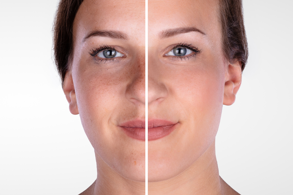 Close-up,Of,A,Young,Woman’s,Face,Before,And,After,Cosmetic