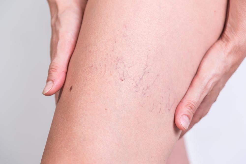 Woman,Indicating,Varicose,Veins,,Veins,,Poor,Circulation,,Spider,Veins