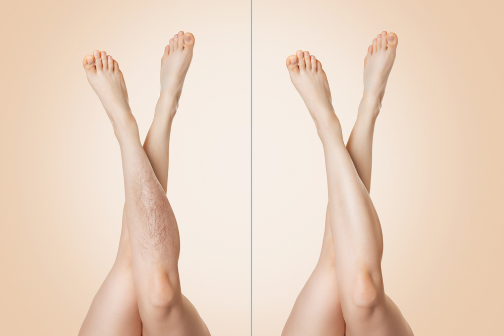 Before,And,After.,Female,Legs,Raised,Up,And,Crossed,With
