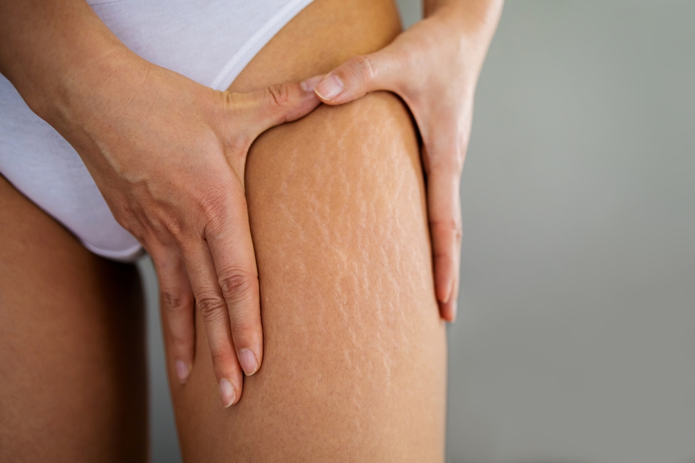 Stretch,Marks,On,Female,Legs.,A,Woman’s,Hand,Holds,A