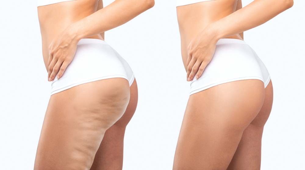 Fat,Woman,With,Cellulite,On,Her,Legs.,Obese,Woman,In