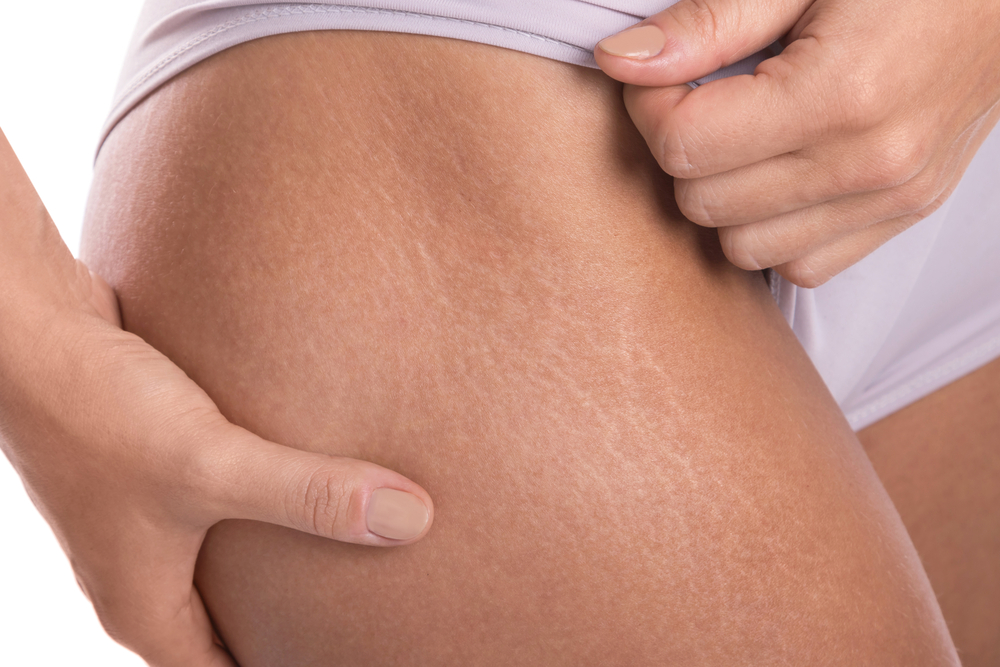 Close,Up,Of,Female,Hips,With,A,Stretch,Marks