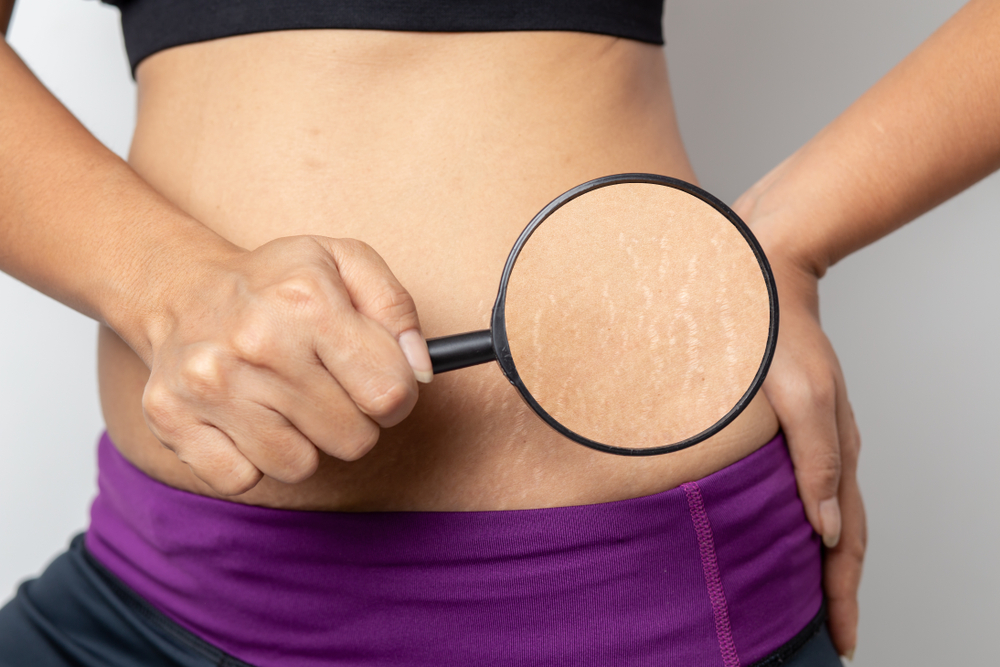Women,Show,Off,The,Belly,After,Birth.,Stretch,Marks,On